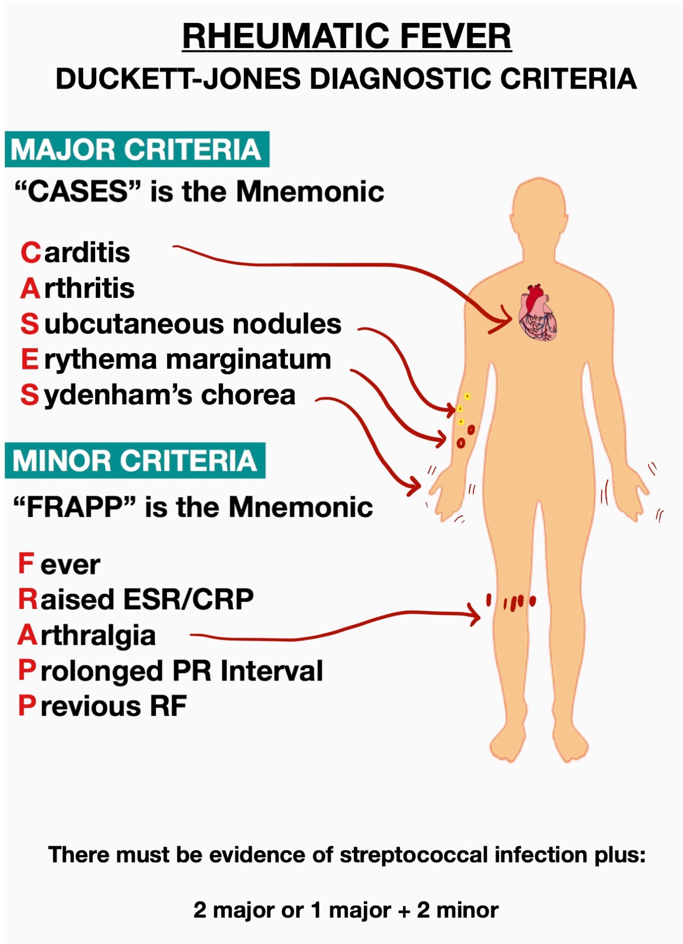 Subcutaneous Nodules Rheumatic Fever