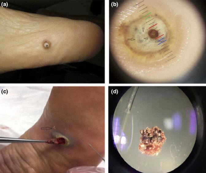 Tungiasis  Medical Junction