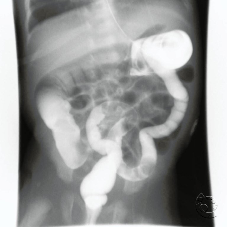 meconium-plug-syndrome-medical-junction