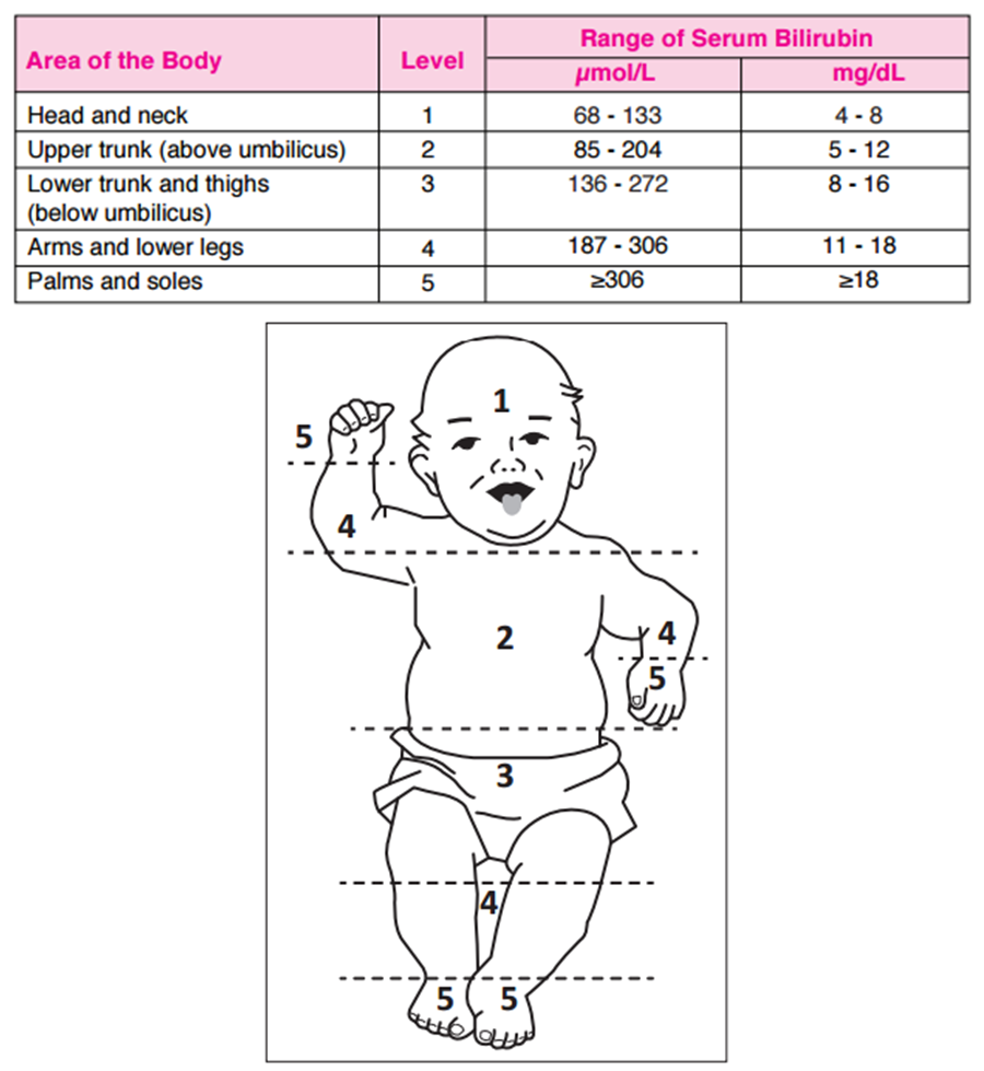 Jaundice neonatal Neonatal Hyperbilirubinemia