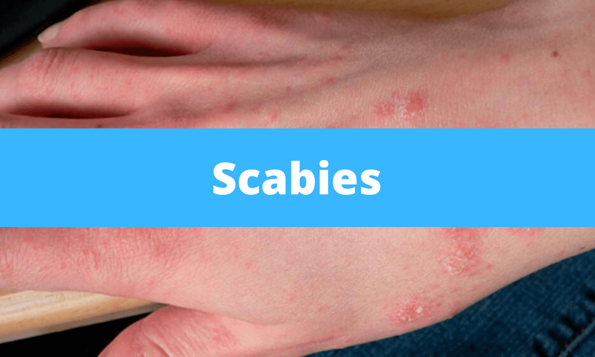 Scabies | Medical Junction