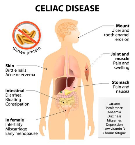 Celiac Disease – Health Education And Services