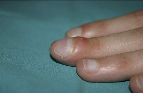 What are the causes of clubbing of single finger? (unidigital clubbing