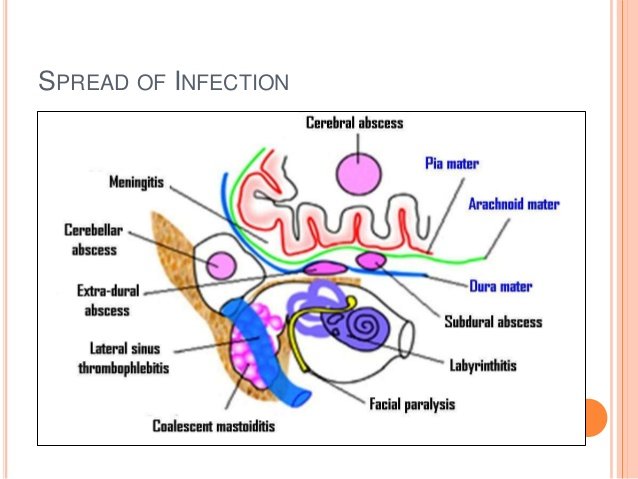 Complications of csom