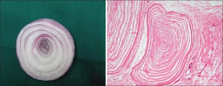 Onion Skin In Medicine | Medical Junction