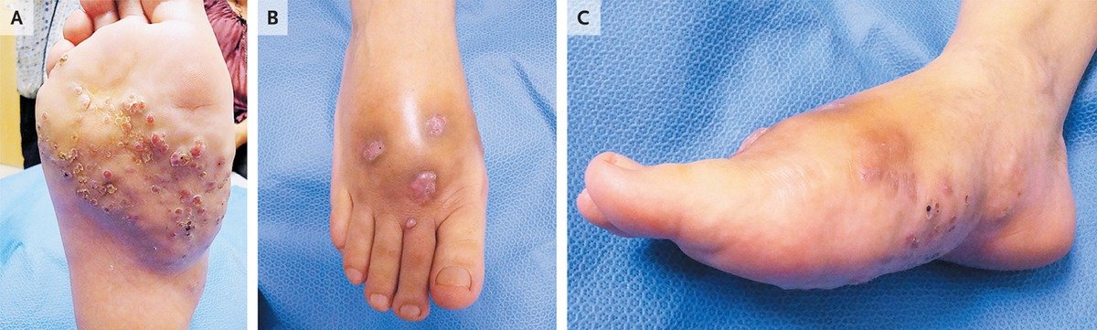 Madura Foot | NEJM