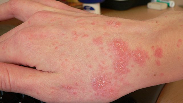 Scabies: Symptoms, Pictures, Treatment & More