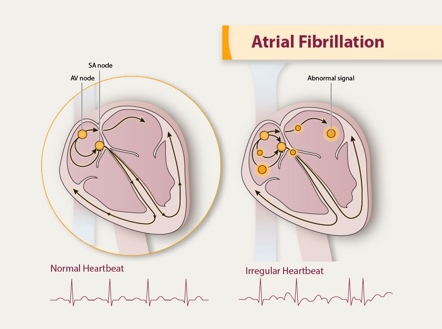 atrial flutter causes mayo clinic