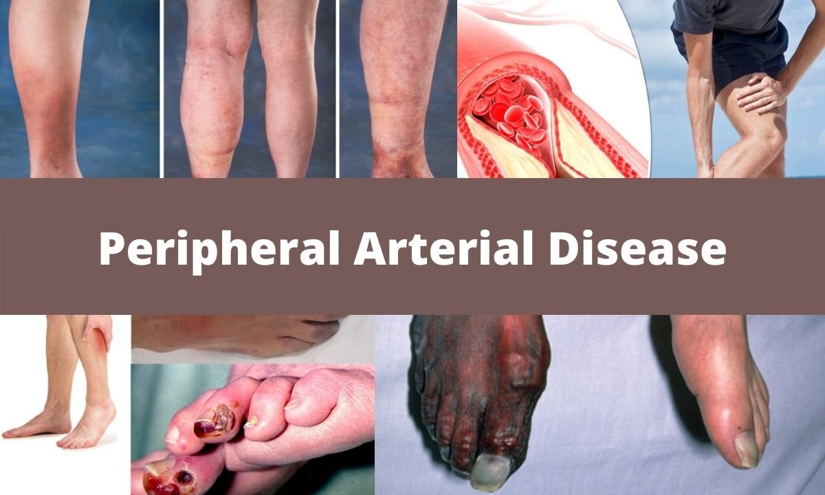 Lower Limb Peripheral Arterial Disease Diagnosis And Management ...