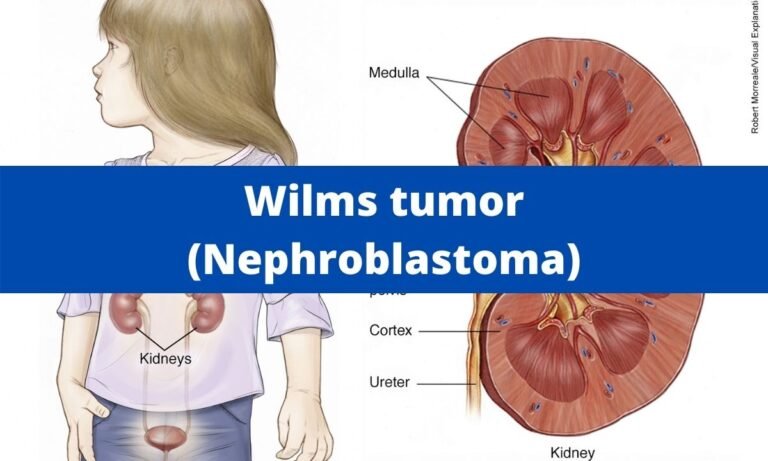 Wilms tumor (Nephroblastoma) | Medical Junction