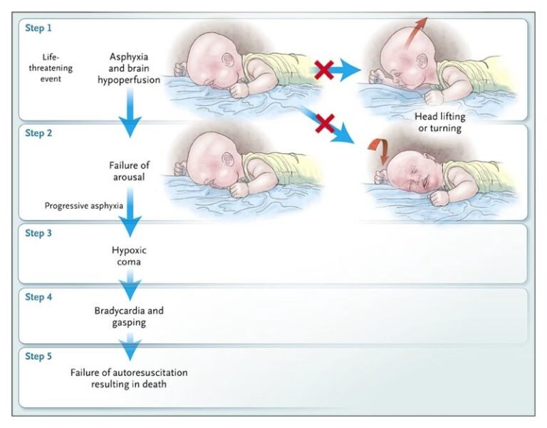 Sudden infant death syndrome (SIDS) | Medical Junction