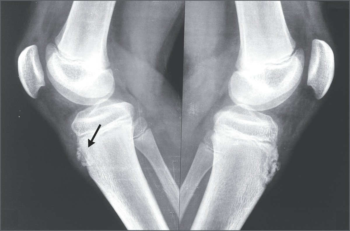 What Does Osd Mean In Medical Terms