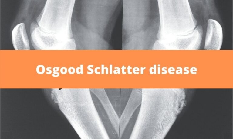 Osgood-schlatters Disease (osd) 