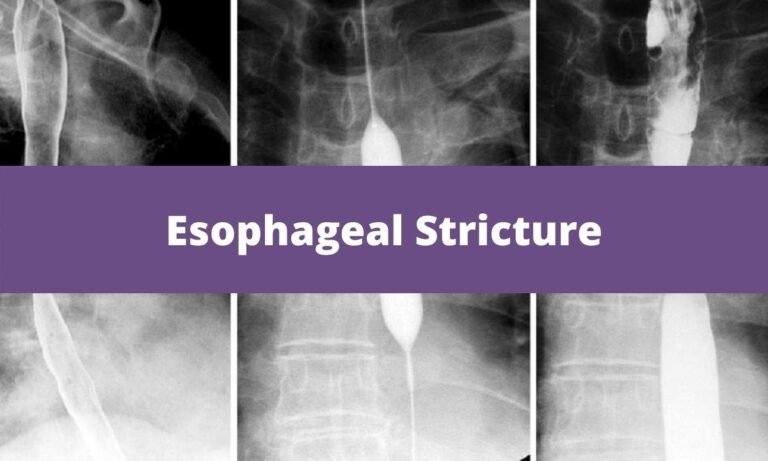 esophageal-stricture-medical-junction