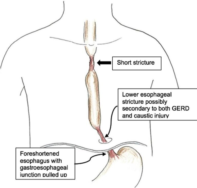 esophageal-stricture-medical-junction