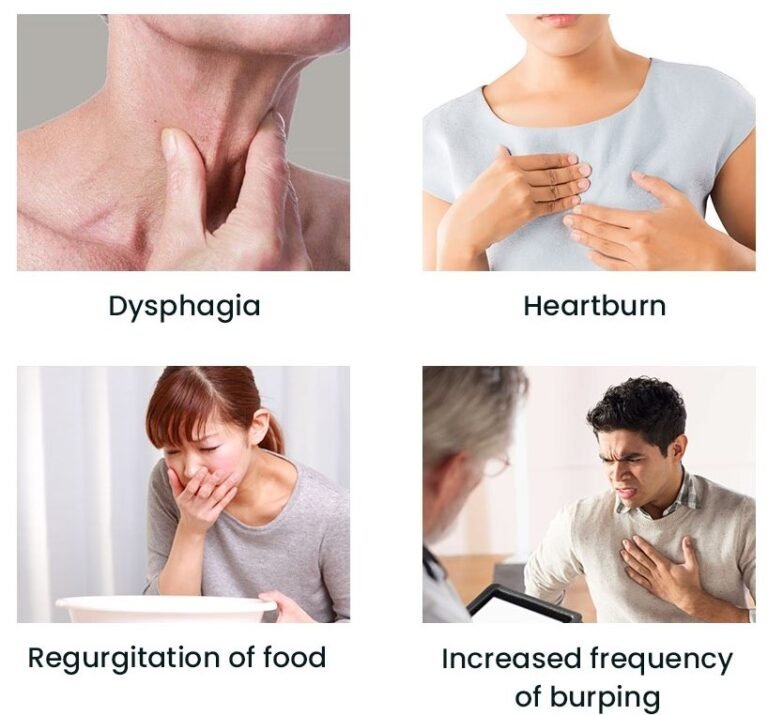 Esophageal Stricture Medical Junction
