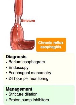 esophageal stenosis