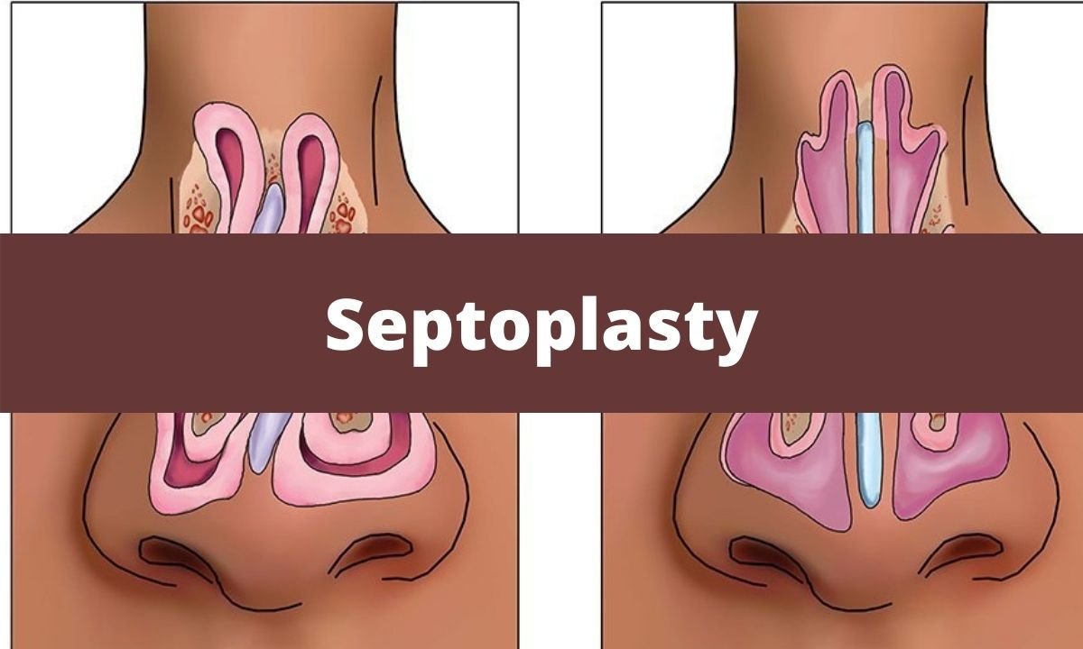 Septoplasty (1)