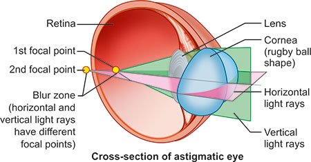 Cross section of astigmatic eye