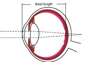 axial hypermetropia