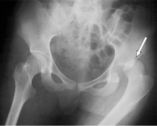 Hip dislocation