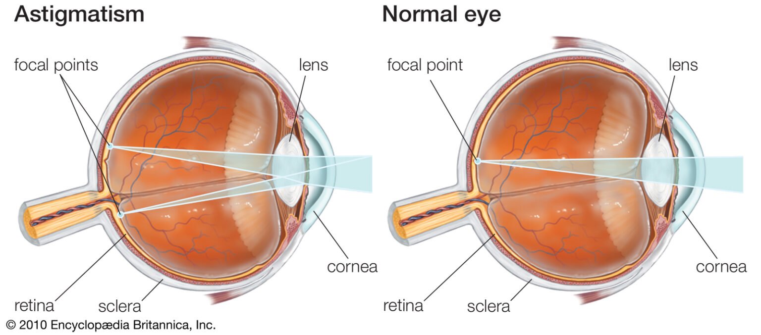 Astigmatism | Medical Junction