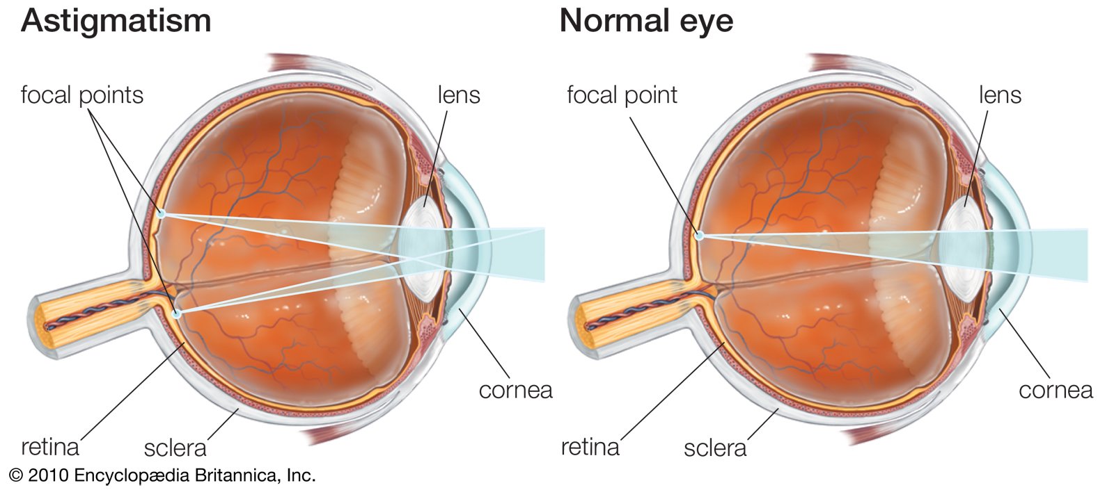 Astigmatism