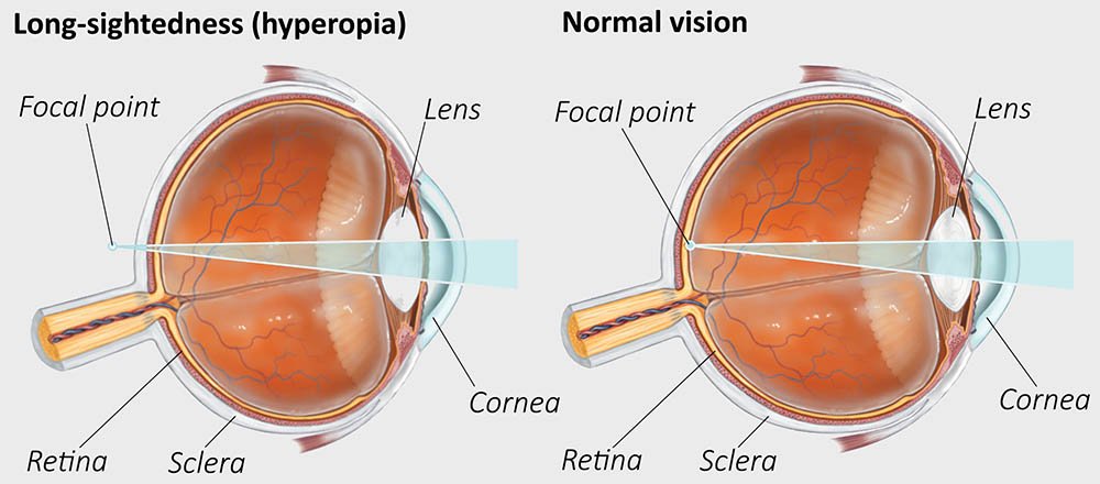 Hyperopia