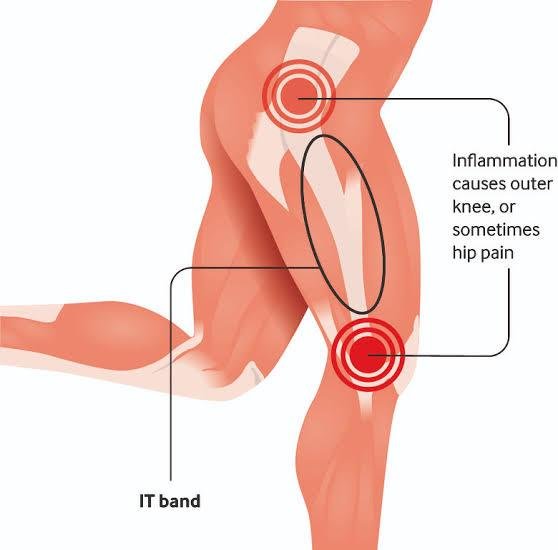 Renne's Test  Iliotibial Band Friction Syndrome ITBS 