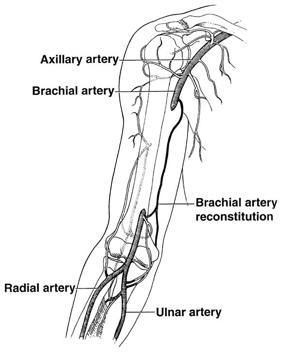 right ulnar artery