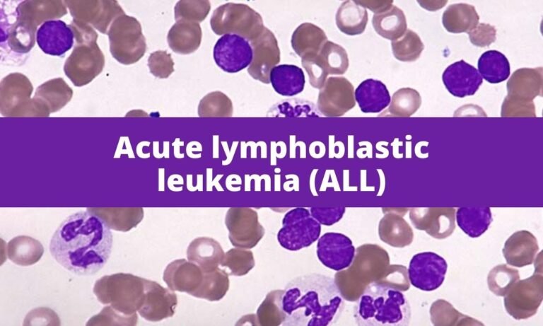 Acute lymphoblastic leukemia (ALL) | Medical Junction