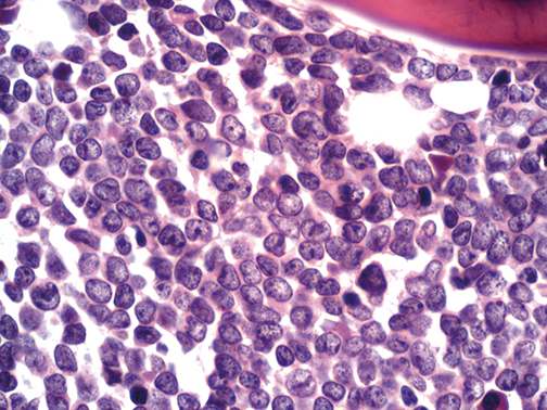 Bone marrow biopsy of a case of B cell acute lymphoblastic leukemia