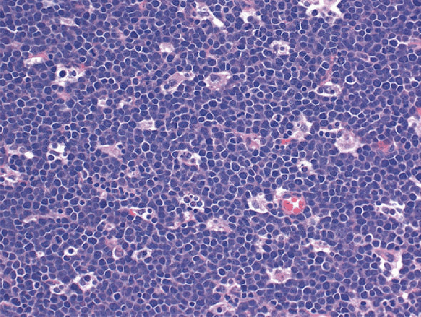 Burkitt lymphoma. The "starry-sky" appearance