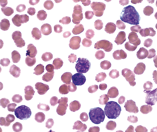 Acute Lymphoblastic Leukemia ALL Medical Junction