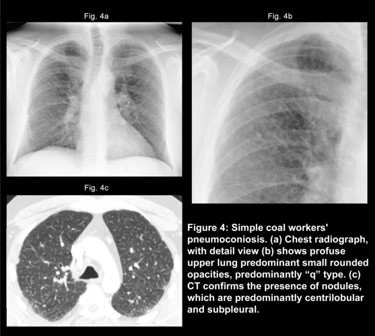 Pneumoconiosis | Medical Junction