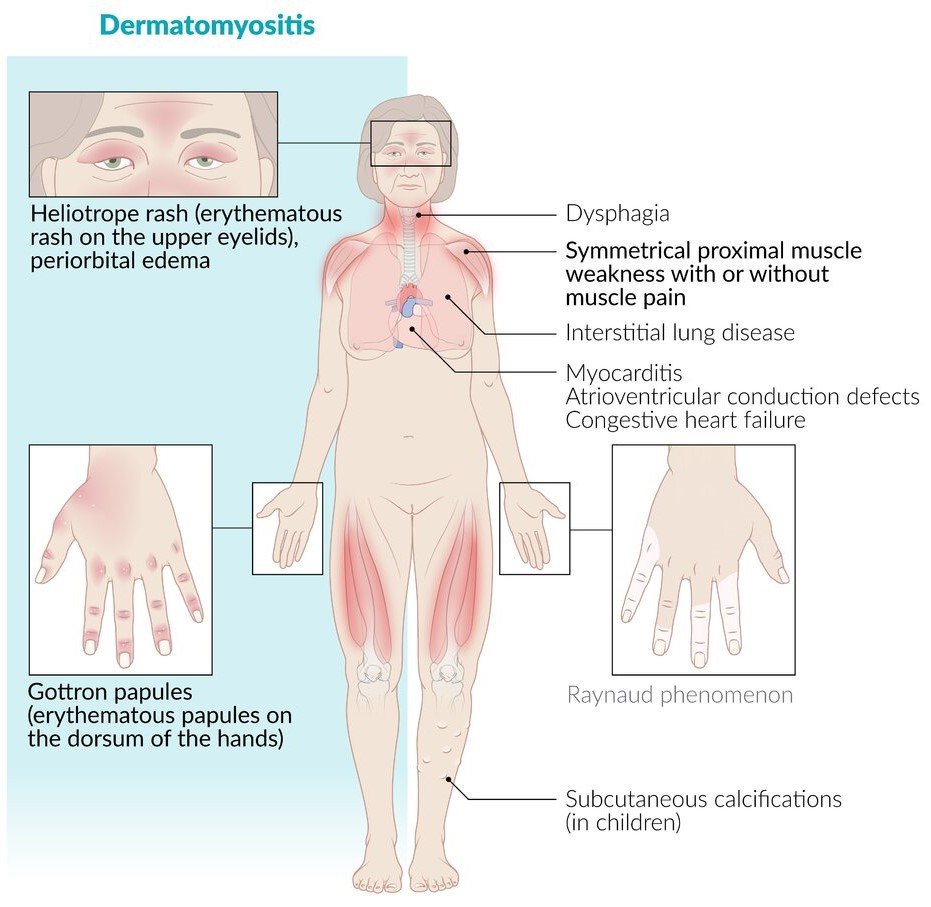 periorbital edema dermatomyositis