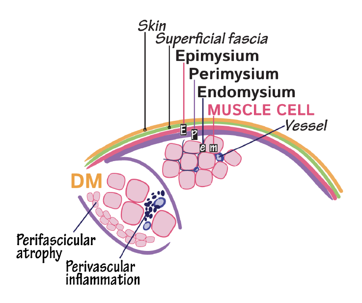 Perifascicular Atrophy